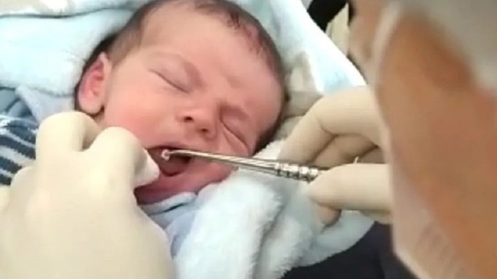 Vídeo: mãe se surpreende ao ver dente crescer em bebê de sete dias em SC