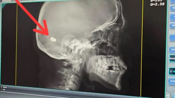 Homem vai ao hospital reclamando de dor de cabeça e descobre bala alojada no crânio