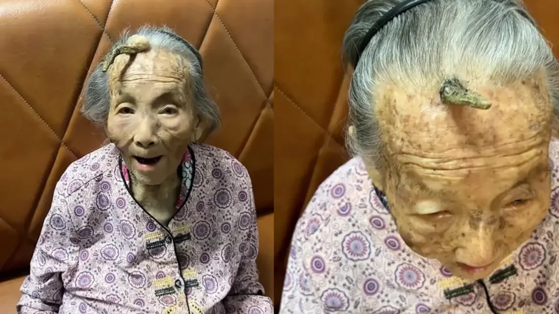 Idosa de 107 anos chama atenção por ‘chifre’ crescendo na testa